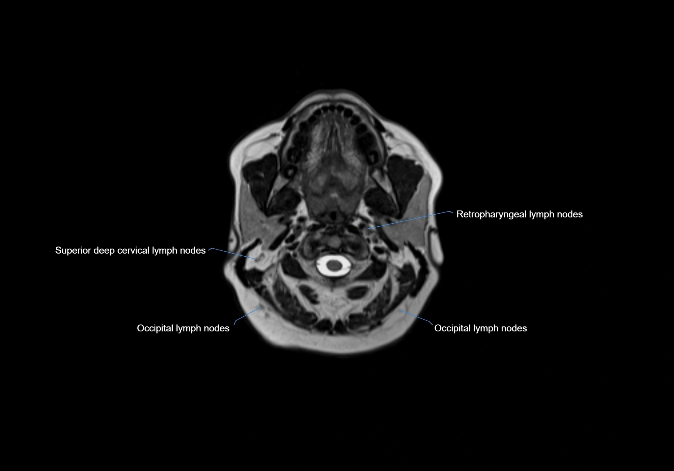 Neck axial  lymph node cross sectional MRI anatomy 3T MRI  image-img-00001-00036.webp